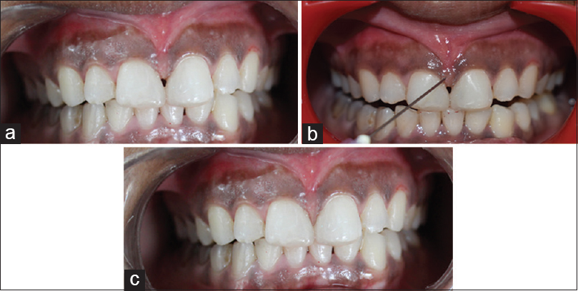 gap in teeth treatment