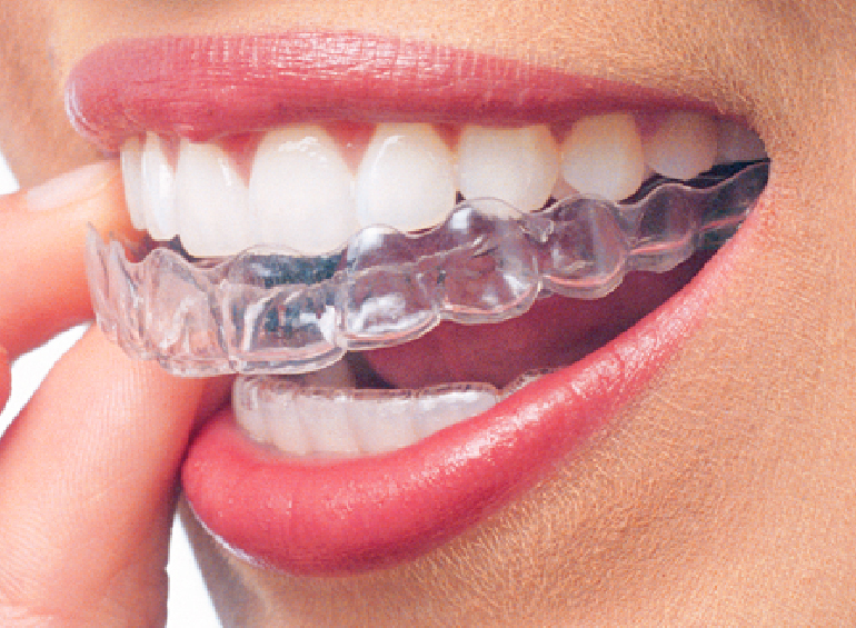 https://ahmedabad-dentist.com/wp-content/uploads/2024/02/clear-aligner-1.jpg