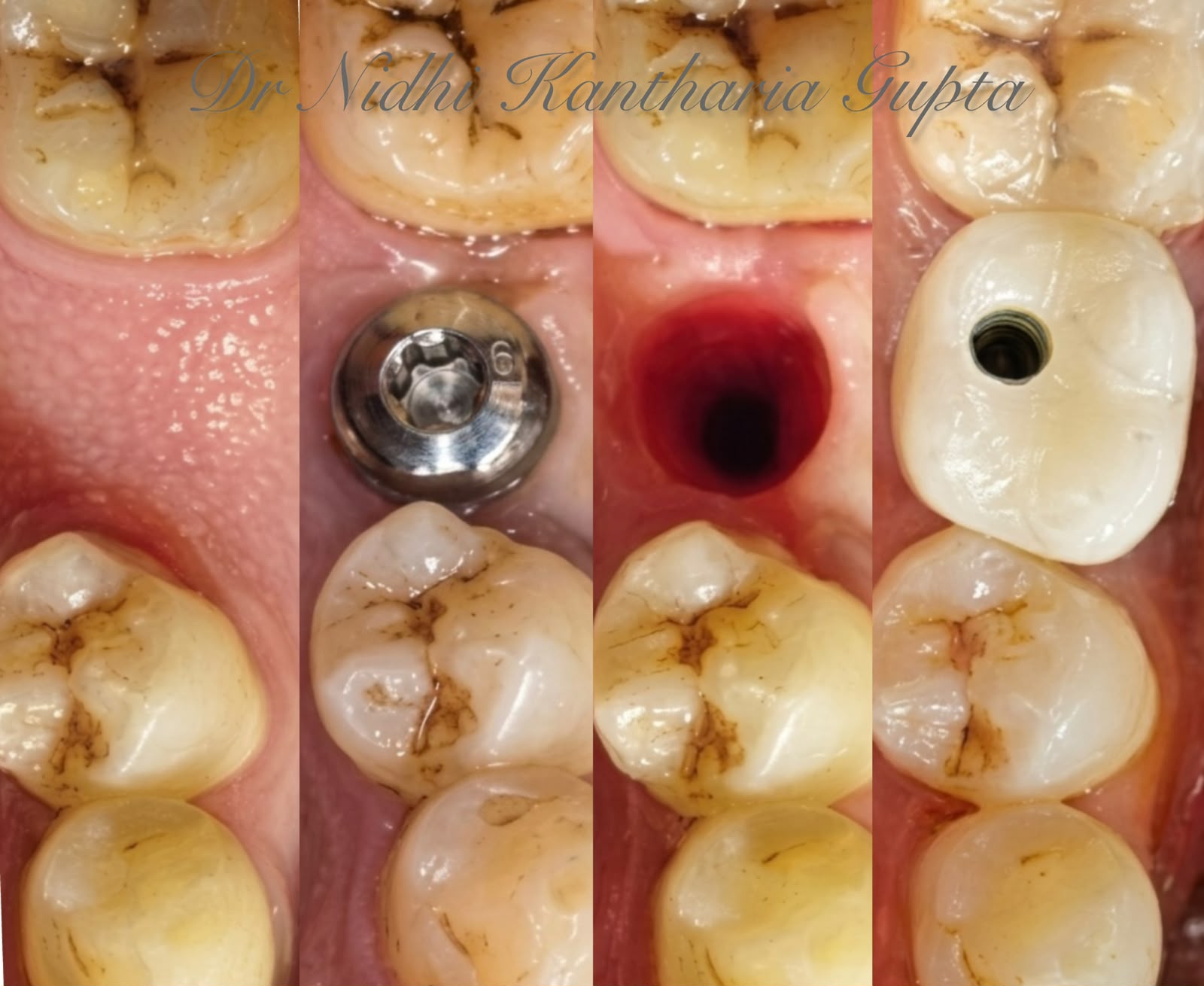 CAN YOU GET DENTAL IMPLANT IMMEDIATELY AFTER TOOTH EXTRACTION ?